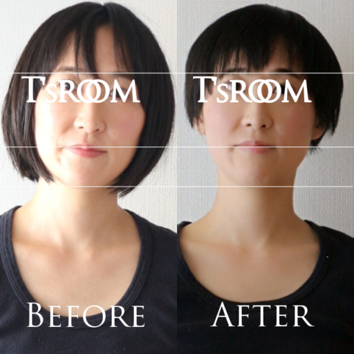 小顔矯正before&after1